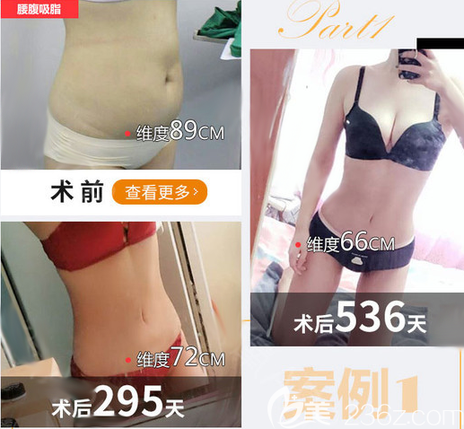 成都艾米麗腰腹吸脂術(shù)前術(shù)后對(duì)比圖 成都艾米麗腰腹吸脂術(shù)前術(shù)后對(duì)比圖