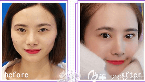 北京紫潔醫(yī)美皮下速接雙眼皮案例