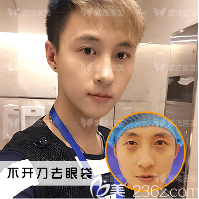 北京紫潔醫(yī)美不開刀祛眼袋案例