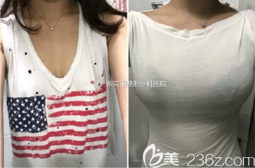 ?？他愙w鏞瑾隆胸案例