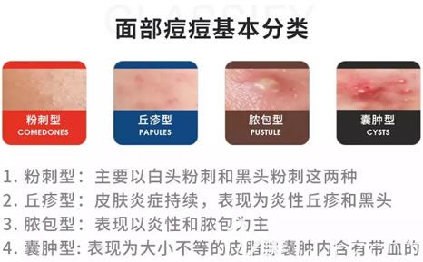 面部痘痘的四大類型