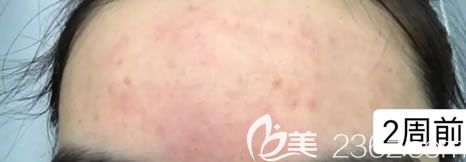 在寧波薇琳做水楊酸祛痘前