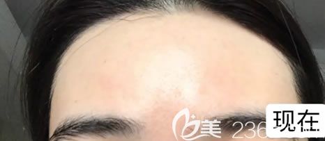 寧波薇琳水楊酸祛痘<span style=