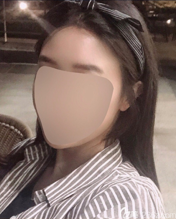 韓國芭堂旻長煥額頭縮小感覺縮小了很多疤痕很細(xì)，總之滿意推薦