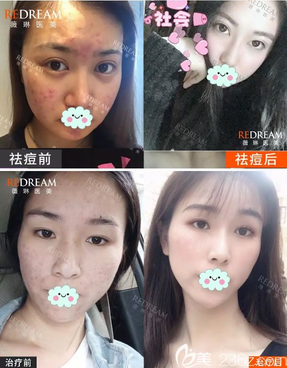寧波薇琳多維祛痘<span style=