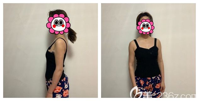 產(chǎn)后胸部下垂萎縮面診南京華韓奇致整形 產(chǎn)后胸部下垂萎縮面診南京華韓奇致整形