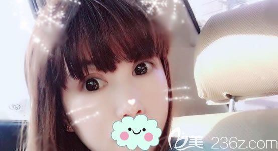 3個(gè)月前在寧波雅韓做了上眼瞼去脂手術(shù)修復(fù)前一次做失敗不對(duì)稱的雙眼皮，現(xiàn)在放效果啦