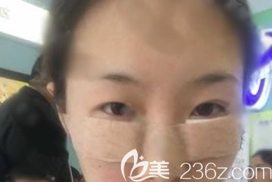 寧波建國整形剛做完去眼袋圖片 寧波建國整形剛做完去眼袋圖片