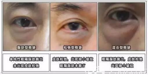 怎么去眼袋的詳細攻略 怎么去眼袋的詳細攻略