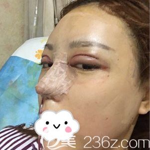 剛做完眼鼻綜合術(shù)后即刻效果