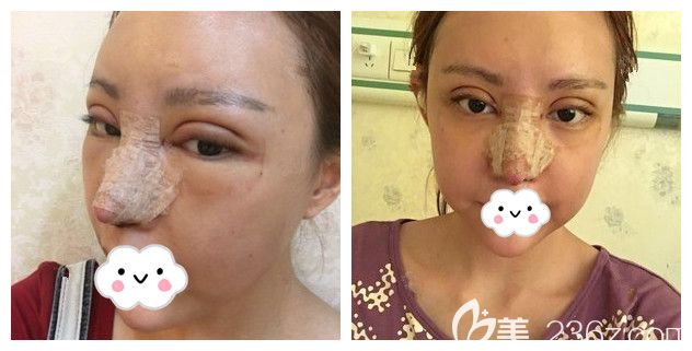 術(shù)后五天眼鼻消腫恢復(fù)的狀態(tài)