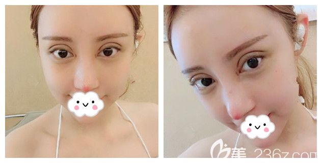 一周拆線后眼鼻恢復(fù)情況