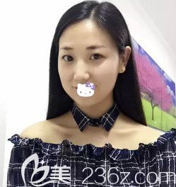 韓鵬醫(yī)生為我注射瘦臉術(shù)后18天瘦臉效果明顯