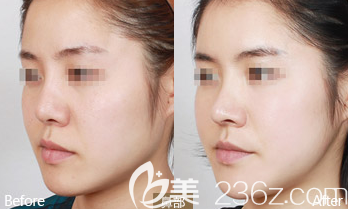 德州友誼隆鼻案例一