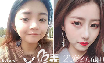 德州友誼隆鼻案例3