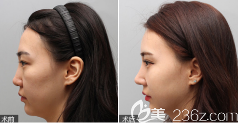 德州天宏假體隆鼻案例1