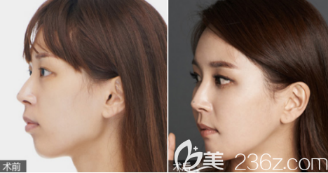 德州天宏假體隆鼻案例2