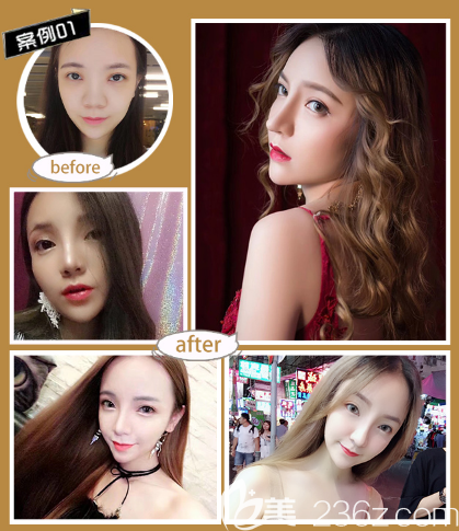 深圳潤澤瑞尼絲王釗院長隆鼻案例