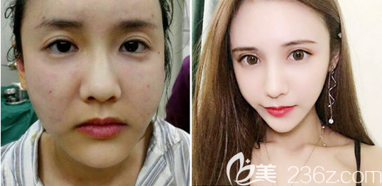 深圳潤澤瑞尼絲王釗院長自體脂肪全臉填充案例