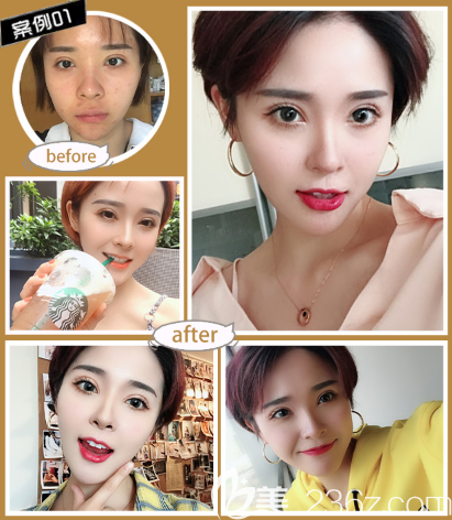 深圳潤澤瑞尼絲馬中衛(wèi)醫(yī)生脂肪填充案例