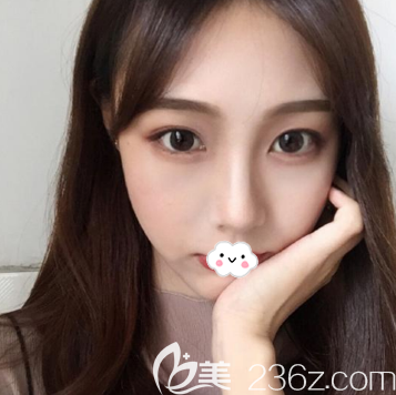 耳軟骨復(fù)合隆鼻術(shù)后10天恢復(fù)效果