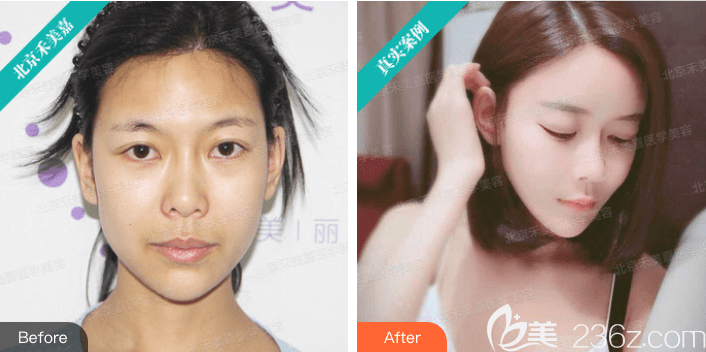 北京禾美嘉任學(xué)會(huì)自體脂肪面部填充案例