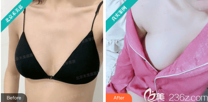 北京禾美嘉任學(xué)會(huì)自體脂肪+假體復(fù)合豐胸案例