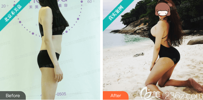 北京禾美嘉任學(xué)會(huì)自體脂肪豐臀案例