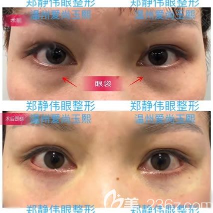 <!--<i data=20240703-sp></i>-->剛做完去眼袋效果