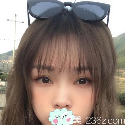 拜拜,眼袋君,我在整形做內(nèi)切去眼袋全記錄,沒眼袋后真是太美好了