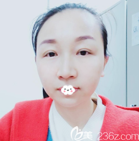 廣州曙光陳天雷線雕提升15天恢復(fù)過程圖 廣州曙光陳天雷線雕提升15天恢復(fù)過程圖