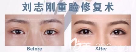 劉志剛院長雙眼皮修復真人前后對比
