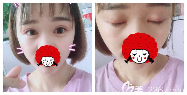 5組照片告訴你為什么我到蘇州紫馨做了雙眼皮+開眼角眼綜合之后又去做了激光美膚+瘦臉