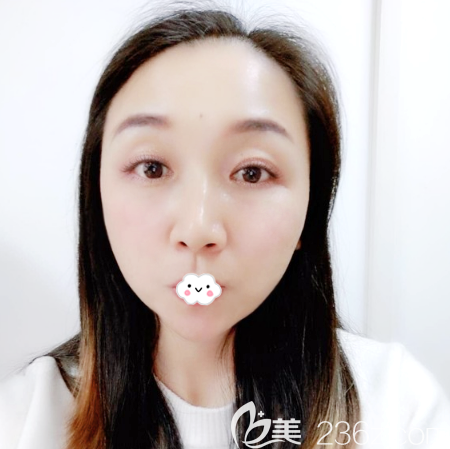 面部線雕埋線提升術(shù)后1個(gè)月效果圖 面部線雕埋線提升術(shù)后1個(gè)月效果圖