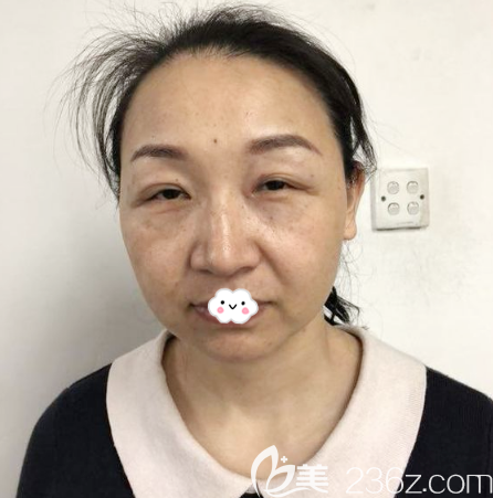 在廣州曙光做線雕提升術(shù)前照片 在廣州曙光做線雕提升術(shù)前照片