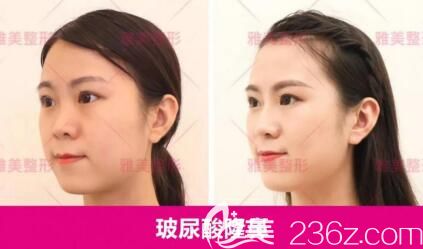 玻尿酸隆鼻真人前后對(duì)比照