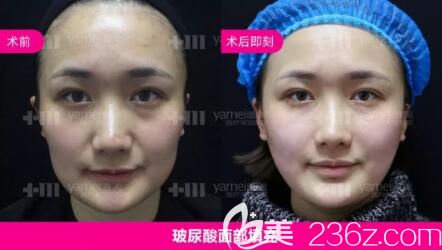 玻尿酸面部填充真人前后對(duì)比照