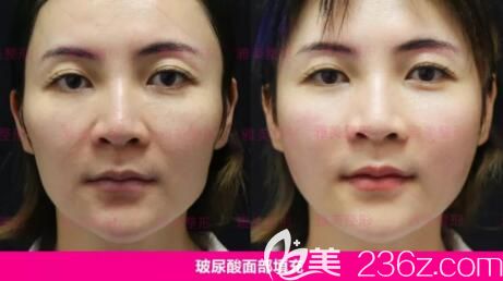 玻尿酸全面部填充真人前后效果對(duì)比照