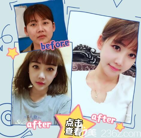 分享注射瘦臉案例