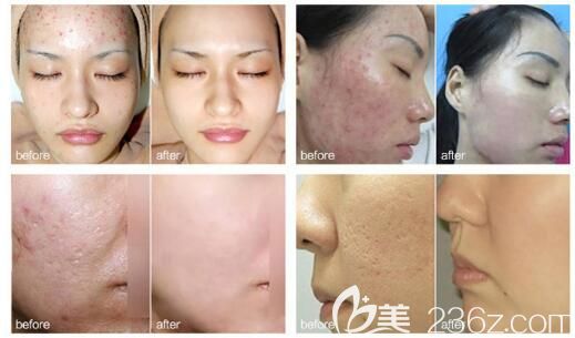 祛痘對(duì)比照