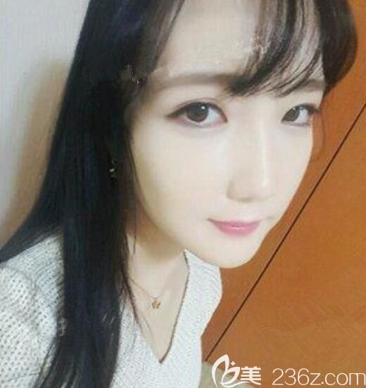 馬臉的我在韓國麗珍整形吳銘埈做了v-line和額頭縮小真心點(diǎn)贊