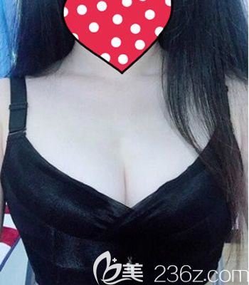 在西寧康華醫(yī)院找做曼托275CC假體隆胸 成功拯救了我干癟的小胸