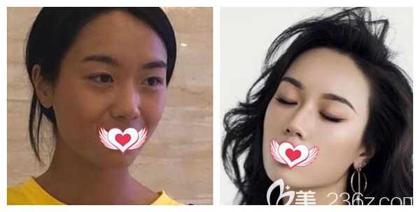 陳寧做自體脂肪填充淚溝案例效果對比圖