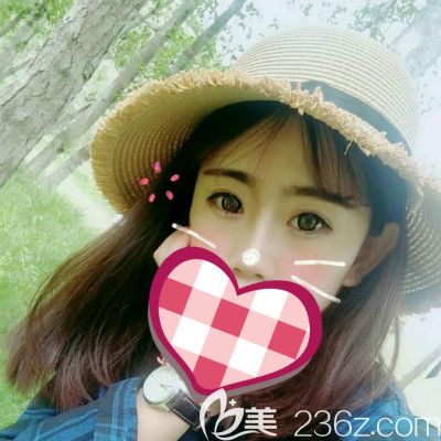 西寧康華醫(yī)院假體+耳軟骨隆鼻案例40天恢復(fù)過(guò)程分享 讓大家在隆鼻路上少走彎路