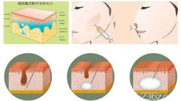 自體脂肪填充淚溝疼嗎