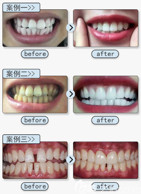 廣州壹加壹口腔牙齒矯正實例 廣州壹加壹口腔牙齒矯正實例