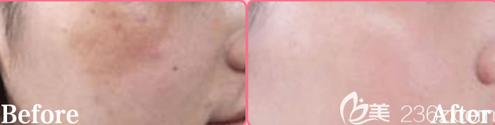 北京藝星祛斑案例