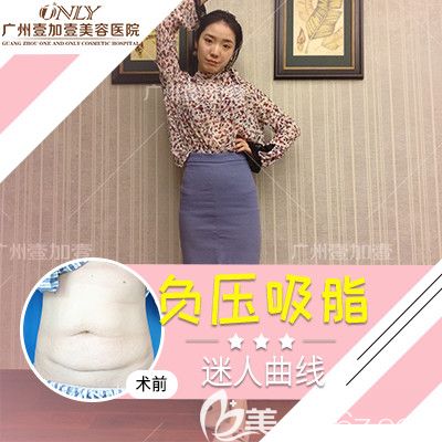 廣州壹加壹李明腰腹部吸脂實例對比圖 廣州壹加壹李明腰腹部吸脂實例對比圖