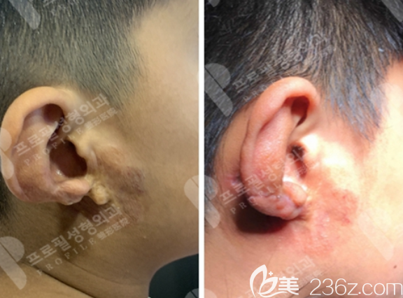 孩子耳朵萎縮8年了韓國普羅菲耳鄭在皓耳朵再造讓兒子終于有了耳朵