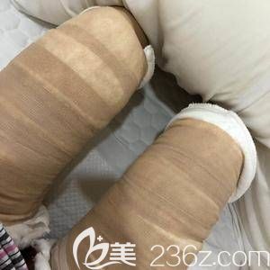 第二天腿上還包著繃帶